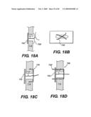 Method and Apparatus for the Treatment of the Intervertebral Disc Annulus diagram and image