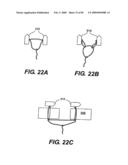 Method and Apparatus for the Treatment of the Intervertebral Disc Annulus diagram and image