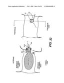 Method and Apparatus for the Treatment of the Intervertebral Disc Annulus diagram and image