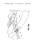 Method and Apparatus for the Treatment of the Intervertebral Disc Annulus diagram and image