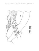 Method and Apparatus for the Treatment of the Intervertebral Disc Annulus diagram and image