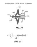 Method and Apparatus for the Treatment of the Intervertebral Disc Annulus diagram and image