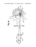 Method and Apparatus for the Treatment of the Intervertebral Disc Annulus diagram and image