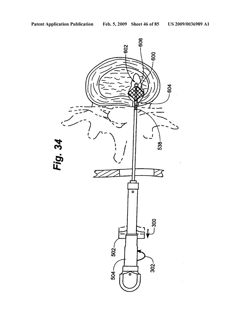 Method and Apparatus for the Treatment of the Intervertebral Disc Annulus - diagram, schematic, and image 47