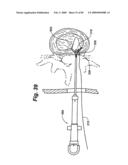 Method and Apparatus for the Treatment of the Intervertebral Disc Annulus diagram and image