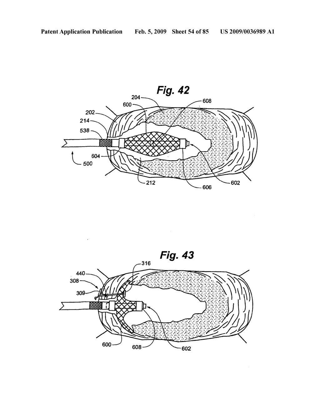Method and Apparatus for the Treatment of the Intervertebral Disc Annulus - diagram, schematic, and image 55