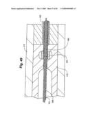 Method and Apparatus for the Treatment of the Intervertebral Disc Annulus diagram and image