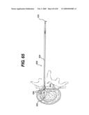 Method and Apparatus for the Treatment of the Intervertebral Disc Annulus diagram and image