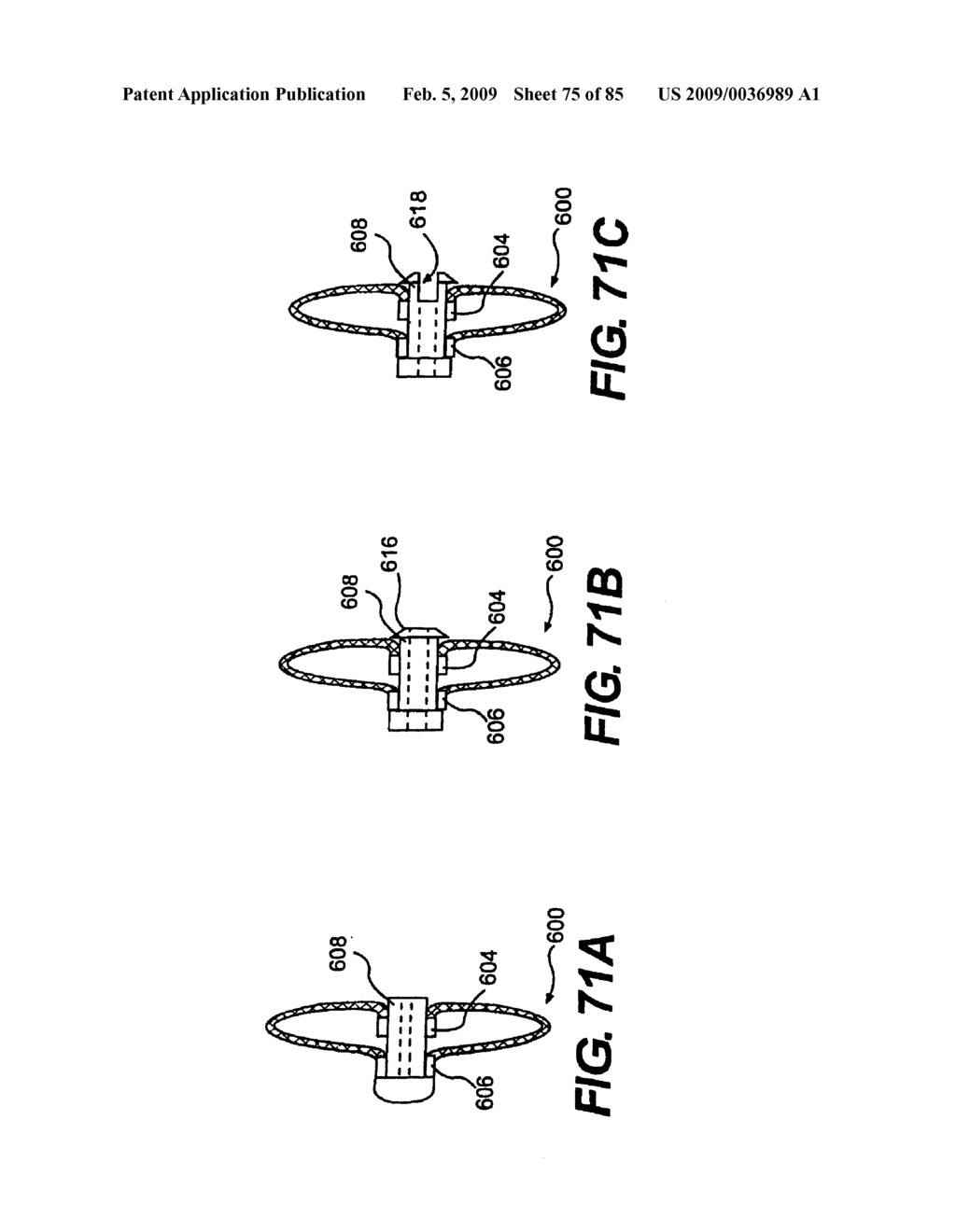 Method and Apparatus for the Treatment of the Intervertebral Disc Annulus - diagram, schematic, and image 76