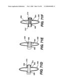 Method and Apparatus for the Treatment of the Intervertebral Disc Annulus diagram and image