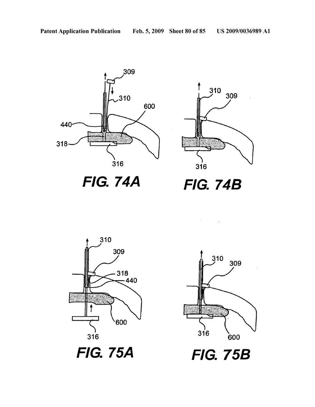 Method and Apparatus for the Treatment of the Intervertebral Disc Annulus - diagram, schematic, and image 81