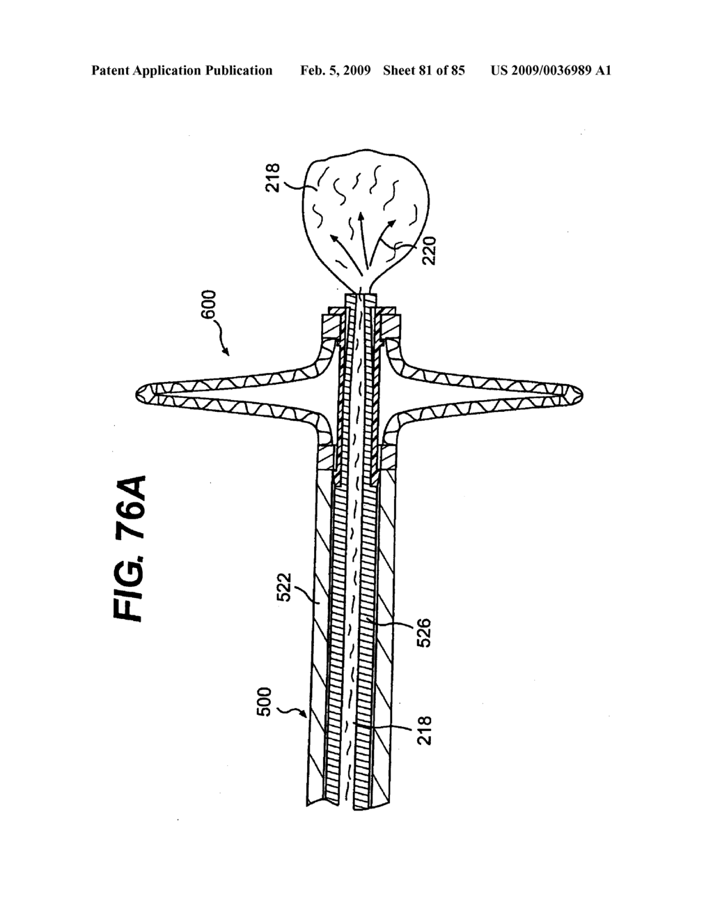 Method and Apparatus for the Treatment of the Intervertebral Disc Annulus - diagram, schematic, and image 82