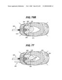 Method and Apparatus for the Treatment of the Intervertebral Disc Annulus diagram and image