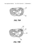 Method and Apparatus for the Treatment of the Intervertebral Disc Annulus diagram and image