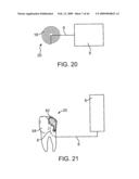 INDUCTIVE POWER TRANSFER SYSTEM FOR PALATAL IMPLANT diagram and image