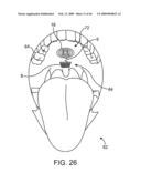 INDUCTIVE POWER TRANSFER SYSTEM FOR PALATAL IMPLANT diagram and image