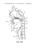 INDUCTIVE POWER TRANSFER SYSTEM FOR PALATAL IMPLANT diagram and image