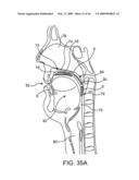 INDUCTIVE POWER TRANSFER SYSTEM FOR PALATAL IMPLANT diagram and image