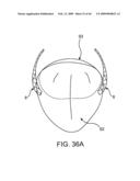 INDUCTIVE POWER TRANSFER SYSTEM FOR PALATAL IMPLANT diagram and image