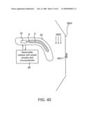 INDUCTIVE POWER TRANSFER SYSTEM FOR PALATAL IMPLANT diagram and image