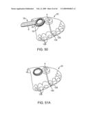 INDUCTIVE POWER TRANSFER SYSTEM FOR PALATAL IMPLANT diagram and image