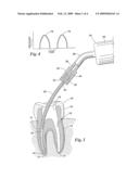 Endodontic Procedure Employing Simultaneous Liquefaction and Acoustic Debridgement diagram and image