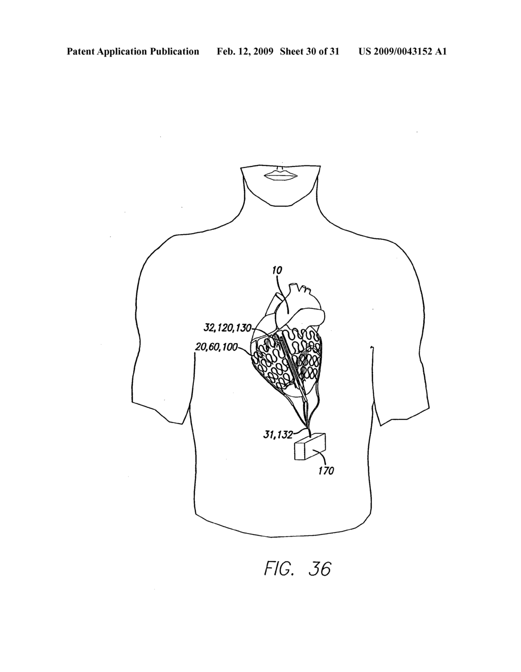 DELIVERY DEVICE FOR CARDIAC HARNESS - diagram, schematic, and image 31