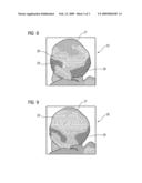 Method for assessing a rupture risk of an aneurysm of a patient and associated system diagram and image