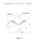 Magnetic Surgical Device to Manipulate Tissue in Laparoscopic Surgeries Performed with a Single Trocar or Via Natural Orifices diagram and image