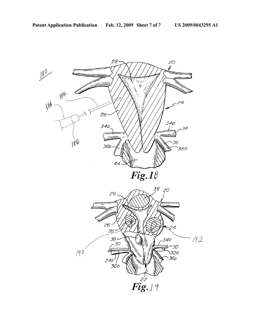 Fibroid Treatment Methods and Devices - diagram, schematic, and image 08