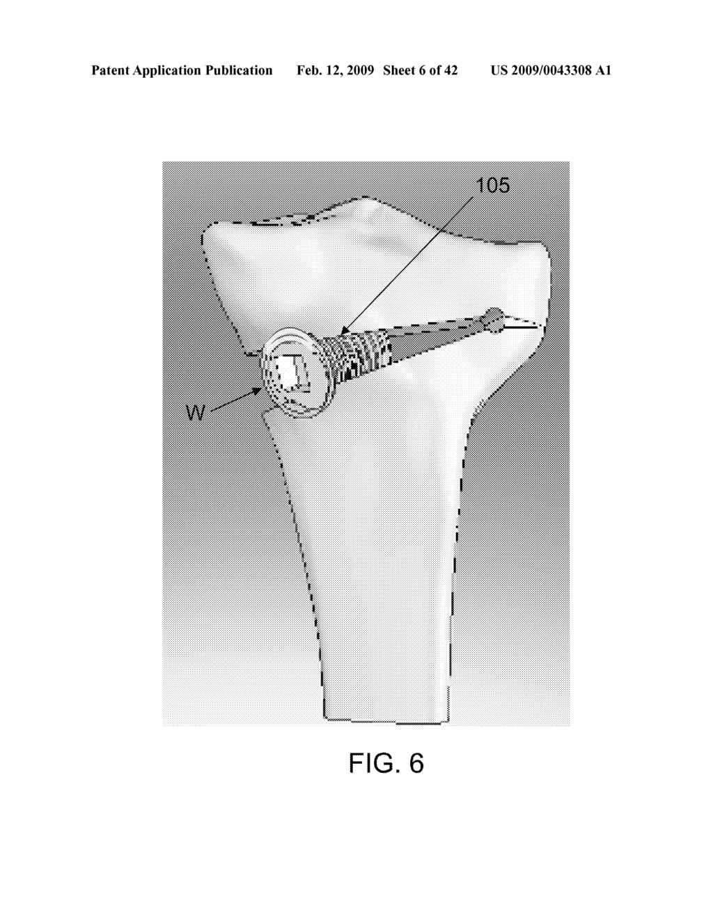 METHOD AND APPARATUS FOR PERFORMING AN OPEN WEDGE OSTEOTOMY - diagram, schematic, and image 07