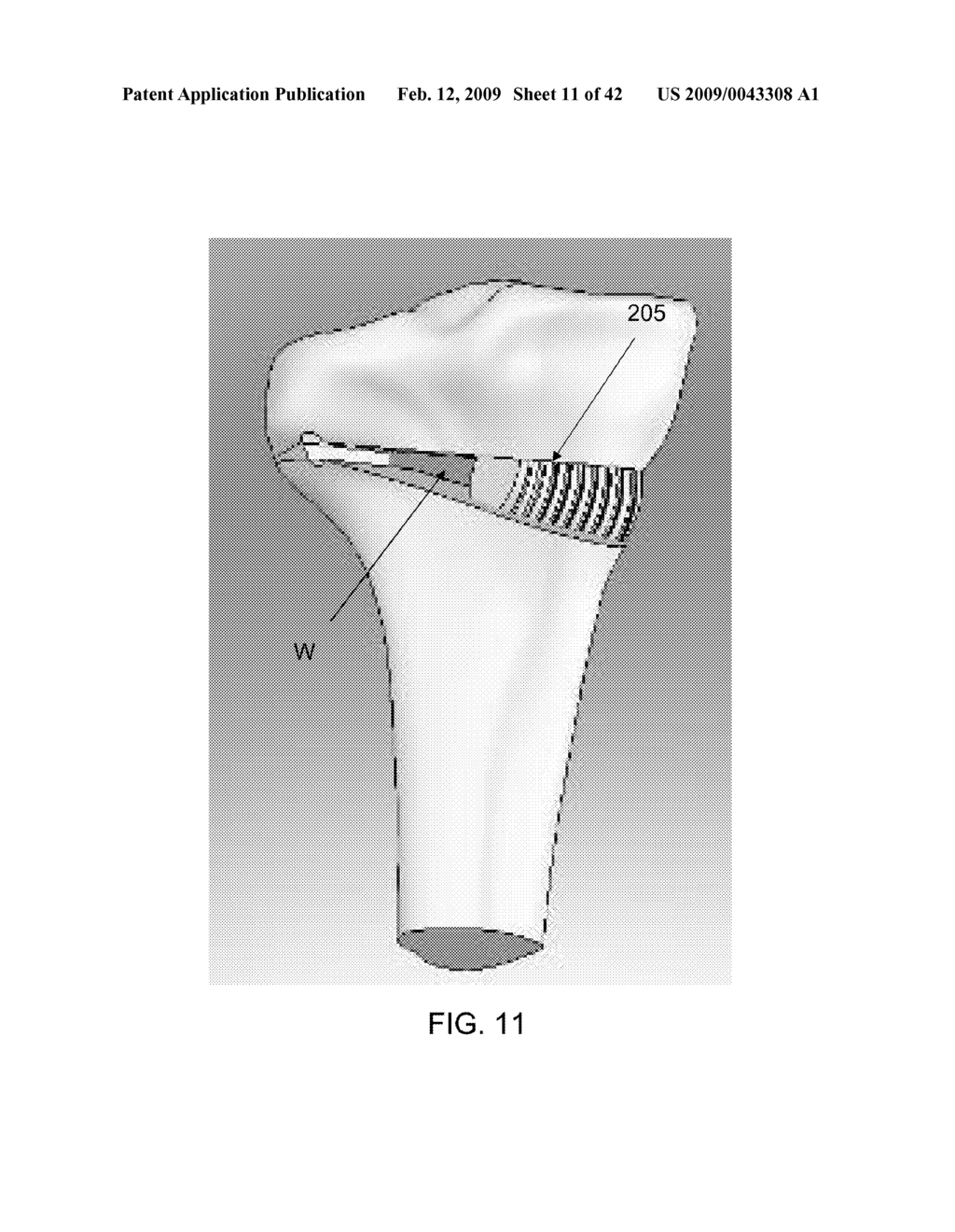 METHOD AND APPARATUS FOR PERFORMING AN OPEN WEDGE OSTEOTOMY - diagram, schematic, and image 12