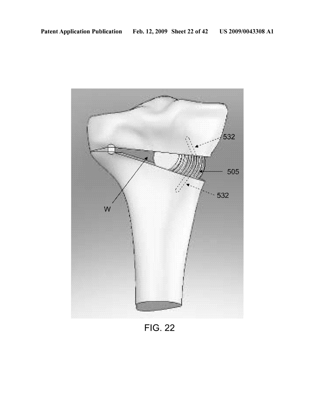 METHOD AND APPARATUS FOR PERFORMING AN OPEN WEDGE OSTEOTOMY - diagram, schematic, and image 23