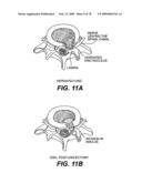 Method and Apparatus for Enhanced Delivery of Treatment Device to the Intervertebral Disc Annulus diagram and image