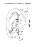 Method and Apparatus for Enhanced Delivery of Treatment Device to the Intervertebral Disc Annulus diagram and image