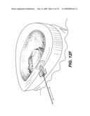 Method and Apparatus for Enhanced Delivery of Treatment Device to the Intervertebral Disc Annulus diagram and image