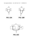 Method and Apparatus for Enhanced Delivery of Treatment Device to the Intervertebral Disc Annulus diagram and image