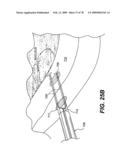 Method and Apparatus for Enhanced Delivery of Treatment Device to the Intervertebral Disc Annulus diagram and image