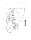 Method and Apparatus for Enhanced Delivery of Treatment Device to the Intervertebral Disc Annulus diagram and image