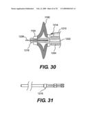 Method and Apparatus for Enhanced Delivery of Treatment Device to the Intervertebral Disc Annulus diagram and image