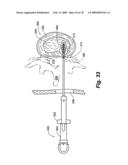 Method and Apparatus for Enhanced Delivery of Treatment Device to the Intervertebral Disc Annulus diagram and image