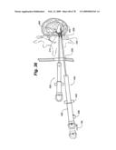 Method and Apparatus for Enhanced Delivery of Treatment Device to the Intervertebral Disc Annulus diagram and image