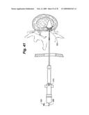 Method and Apparatus for Enhanced Delivery of Treatment Device to the Intervertebral Disc Annulus diagram and image