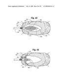 Method and Apparatus for Enhanced Delivery of Treatment Device to the Intervertebral Disc Annulus diagram and image