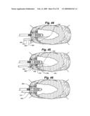 Method and Apparatus for Enhanced Delivery of Treatment Device to the Intervertebral Disc Annulus diagram and image