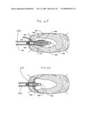 Method and Apparatus for Enhanced Delivery of Treatment Device to the Intervertebral Disc Annulus diagram and image