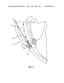 METHODS, APPARATUSES, AND SYSTEMS FOR REDUCING INTRAOCULAR PRESSURE AS A MEANS OF PREVENTING OR TREATING OPEN-ANGLE GLAUCOMA diagram and image