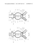 ENDOLUMINAL DEVICE INCLUDING A MECHANISM FOR PROXIMAL OR DISTAL FIXATION, AND SEALING AND METHODS OF USE THEREOF diagram and image