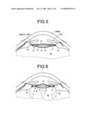 INTRAOCULAR LENS diagram and image