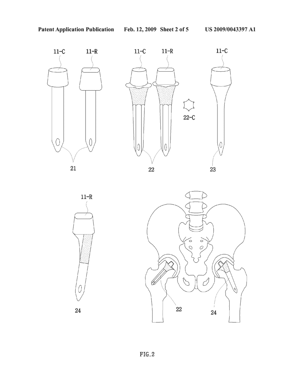 Modular Femoral Head Surface Replacement, Modular Femoral Neck Stem, and Related Sleeve, Adapter, and Osteoconducting Rod - diagram, schematic, and image 03